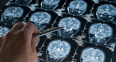 repte prevencio alzheimer
