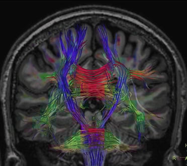 Imagen2b_tracto_coronal2