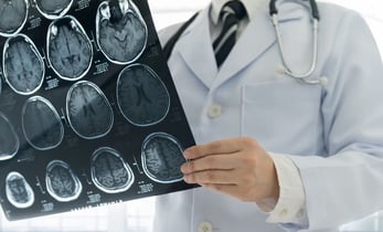 microinfartos-cerebrales