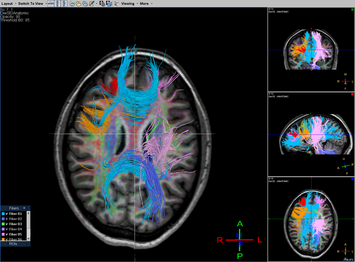 resonancia magnetica cerebral anatomicas