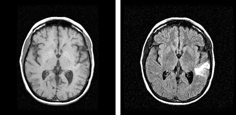 resonancia magnetica cerebral lesiones