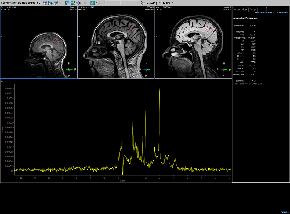 resonancia magnetica cerebral quimico
