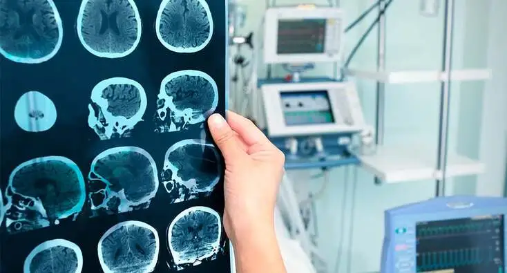 Què passa en un cervell afectat d'Alzheimer 